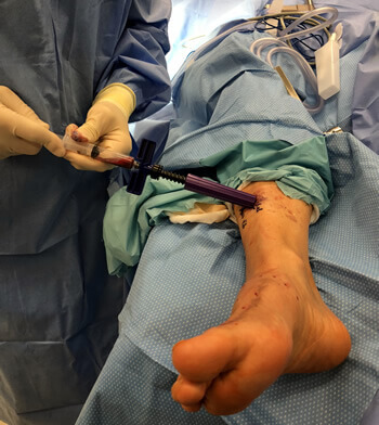 Non-Unions / Bone Marrow in the Bergen County, NJ: Fair Lawn (Ridgewood, Glen Rock, Woodcliff Lake, Hillsdale, Westwood, Closter, Wyckoff, Ramsey, Oakland) and Englewood (Hackensack, Paramus, Tenafly, Closter, Northvale, East Rutherford); Morris County, NJ: Riverdale (Butler, Kinnelon, Montville, Boonton, Pequannock Township, Lincoln Park) as well as Passaic County, NJ (Hawthorne, Paterson, Clifton, Totowa, Pompton Lakes, Wanaque, Wayne, Macopin, Ringwood) and Hudson County, NJ (Secaucus, North Bergen) areas