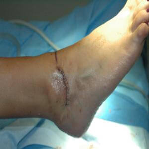 Ankle_instability in the Bergen County, NJ: Fair Lawn (Ridgewood, Glen Rock, Woodcliff Lake, Hillsdale, Westwood, Closter, Wyckoff, Ramsey, Oakland) and Englewood (Hackensack, Paramus, Tenafly, Closter, Northvale, East Rutherford); Morris County, NJ: Riverdale (Butler, Kinnelon, Montville, Boonton, Pequannock Township, Lincoln Park) as well as Passaic County, NJ (Hawthorne, Paterson, Clifton, Totowa, Pompton Lakes, Wanaque, Wayne, Macopin, Ringwood) and Hudson County, NJ (Secaucus, North Bergen) areas