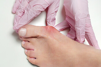 Hallux valgus, bunion in foot on white background