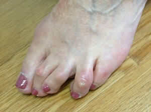 bunions 10