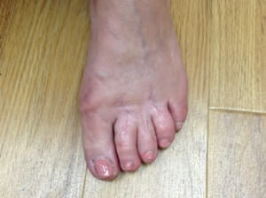 bunions 11