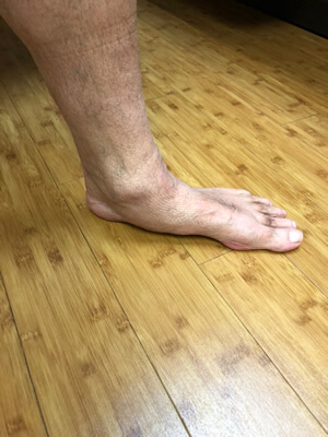 flat foot evaluation 1