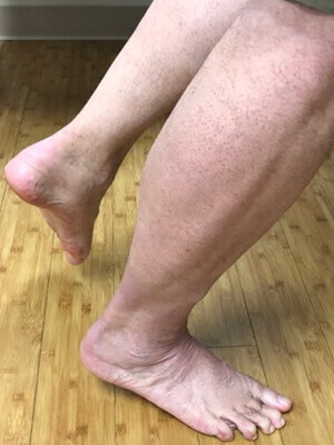 flat foot evaluation 3