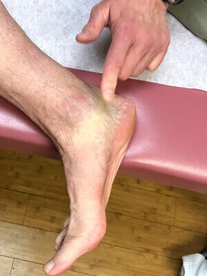 flat foot evaluation 4