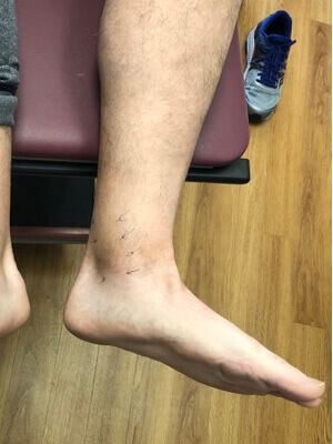 Podiatrist in the Bergen County, NJ: Fair Lawn (Ridgewood, Glen Rock, Woodcliff Lake, Hillsdale, Westwood, Closter, Wyckoff, Ramsey, Oakland) and Englewood (Hackensack, Paramus, Tenafly, Closter, Northvale, East Rutherford); Morris County, NJ: Riverdale (Butler, Kinnelon, Montville, Boonton, Pequannock Township, Lincoln Park) as well as Passaic County, NJ (Hawthorne, Paterson, Clifton, Totowa, Pompton Lakes, Wanaque, Wayne, Macopin, Ringwood) and Hudson County, NJ (Secaucus, North Bergen) areas