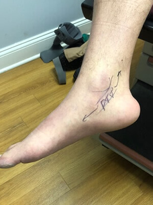 Flat feet treatment in the Bergen County, NJ: Fair Lawn (Ridgewood, Glen Rock, Woodcliff Lake, Hillsdale, Westwood, Closter, Wyckoff, Ramsey, Oakland) and Englewood (Hackensack, Paramus, Tenafly, Closter, Northvale, East Rutherford); Morris County, NJ: Riverdale (Butler, Kinnelon, Montville, Boonton, Pequannock Township, Lincoln Park) as well as Passaic County, NJ (Hawthorne, Paterson, Clifton, Totowa, Pompton Lakes, Wanaque, Wayne, Macopin, Ringwood) and Hudson County, NJ (Secaucus, North Bergen) areas