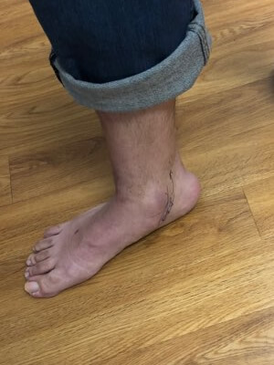 flat foot evaluation 8