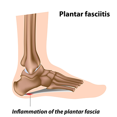 sudden severe heel pain