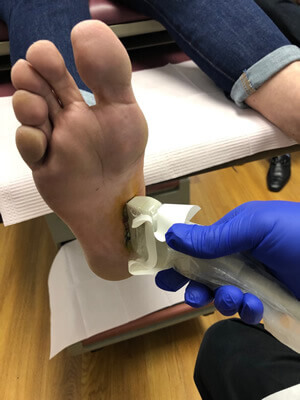 Treatment for outlet plantar fibromatosis