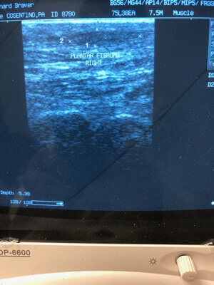 plantar fibroma treatment in the Bergen County, NJ: Fair Lawn (Ridgewood, Glen Rock, Woodcliff Lake, Hillsdale, Westwood, Closter, Wyckoff, Ramsey, Oakland) and Englewood (Hackensack, Paramus, Tenafly, Closter, Northvale, East Rutherford); Morris County, NJ: Riverdale (Butler, Kinnelon, Montville, Boonton, Pequannock Township, Lincoln Park) as well as Passaic County, NJ (Hawthorne, Paterson, Clifton, Totowa, Pompton Lakes, Wanaque, Wayne, Macopin, Ringwood) and Hudson County, NJ (Secaucus, North Bergen) areas