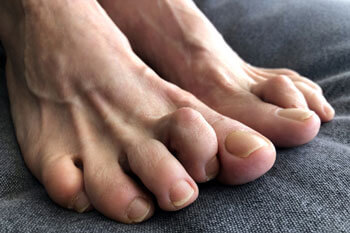 hammertoe specialist, podiatrist in the Bergen County, NJ: Fair Lawn (Ridgewood, Glen Rock, Woodcliff Lake, Hillsdale, Westwood, Closter, Wyckoff, Ramsey, Oakland) and Englewood (Hackensack, Paramus, Tenafly, Closter, Northvale, East Rutherford); Morris County, NJ: Riverdale (Butler, Kinnelon, Montville, Boonton, Pequannock Township, Lincoln Park) as well as Passaic County, NJ (Hawthorne, Paterson, Clifton, Totowa, Pompton Lakes, Wanaque, Wayne, Macopin, Ringwood) and Hudson County, NJ (Secaucus, North Bergen) areas
