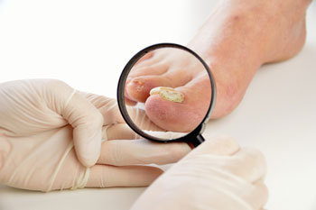 Toenail fungus treatment in the Bergen County, NJ: Fair Lawn (Ridgewood, Glen Rock, Woodcliff Lake, Hillsdale, Westwood, Closter, Wyckoff, Ramsey, Oakland) and Englewood (Hackensack, Paramus, Tenafly, Closter, Northvale, East Rutherford); Morris County, NJ: Riverdale (Butler, Kinnelon, Montville, Boonton, Pequannock Township, Lincoln Park) as well as Passaic County, NJ (Hawthorne, Paterson, Clifton, Totowa, Pompton Lakes, Wanaque, Wayne, Macopin, Ringwood) and Hudson County, NJ (Secaucus, North Bergen) areas