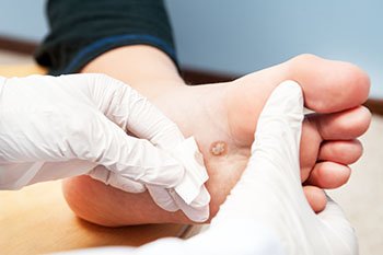 Plantar Warts Treatment in the Bergen County, NJ: Fair Lawn (Ridgewood, Glen Rock, Woodcliff Lake, Hillsdale, Westwood, Closter, Wyckoff, Ramsey, Oakland) and Englewood (Hackensack, Paramus, Tenafly, Closter, Northvale, East Rutherford); Morris County, NJ: Riverdale (Butler, Kinnelon, Montville, Boonton, Pequannock Township, Lincoln Park) as well as Passaic County, NJ (Hawthorne, Paterson, Clifton, Totowa, Pompton Lakes, Wanaque, Wayne, Macopin, Ringwood) and Hudson County, NJ (Secaucus, North Bergen) areas