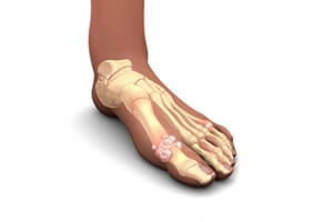 Risk Factors of Gout in Women
