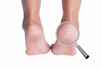 Can Having Regular Pedicures Help to Heal Cracked Heels?