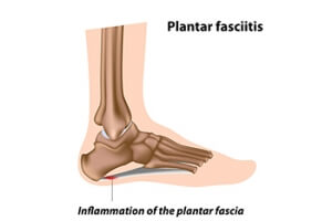 Plantar Fasciitis and Jumping Rope