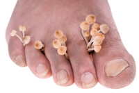 What is Athlete’s Foot and How is it Treated?