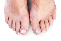 The Effects of Psoriatic Arthritis on the Feet and Ankles