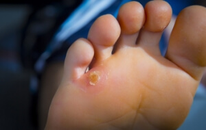 Treatment for Corns