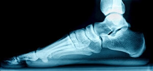 What Type of Flat Feet Do I Have?