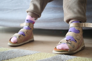 The Role of Custom Insoles for Children with Flexible Flat Feet