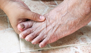 What Is Toenail Fungus and How Is It Treated?