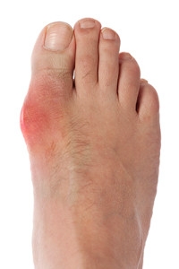 How to Lessen the Effects of Gout