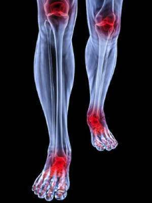 Symptoms of Rheumatoid Arthritis