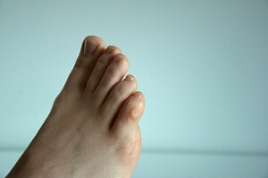 Wearing the Wrong Shoes May Cause a Corn to Develop