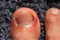 How Do I Know If I Have an Ingrown Toenail?