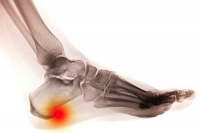 Are Heel Spurs Painful?