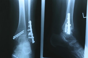 Do I Have a Stress Fracture?