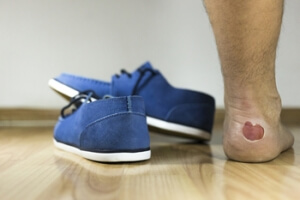 Blisters and Shoes Without Socks