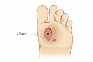 Foot Ulcers Caused by Diabetes