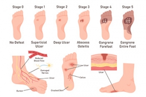 Dangers of Gangrene in Diabetic Patients